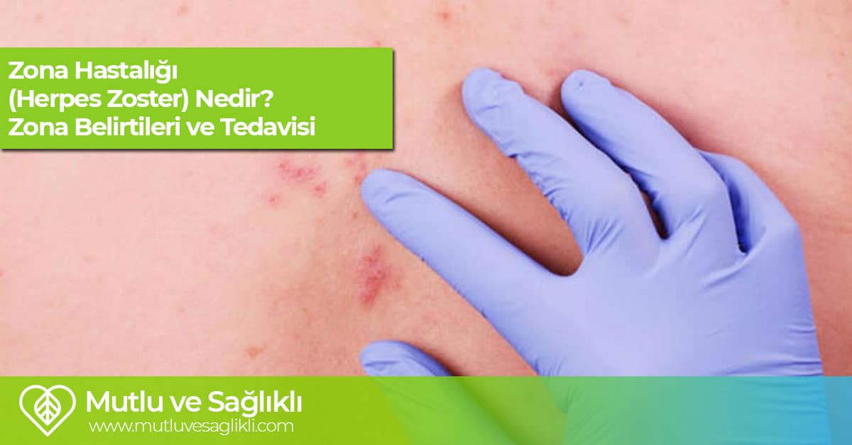 Zona Hastalığı Herpes Zoster Nedir Zona Hastalığı Belirtileri ve